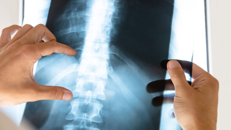 Personal Injury + Medical Negligence: Spinal Injuries